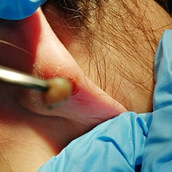 asportazione cisti orecchio laser