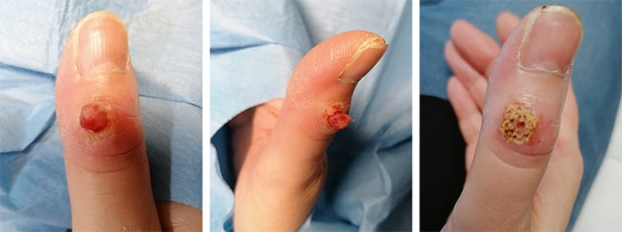 asportazione laser verruca virale dito mano